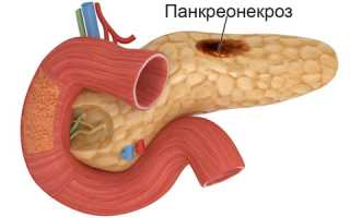 Очаговый панкреонекроз