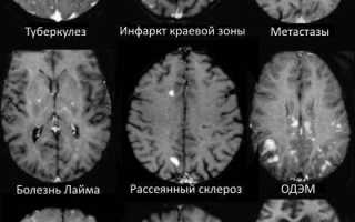 Мелкоочаговые изменения вещества мозга дисциркуляторного характера
