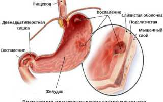 Хронический гастродуоденит в стадии обострения