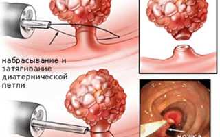 Новообразования в желудке