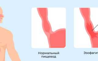 Хронический дистадльный эзофагит – признаки и лечение