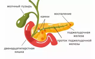 Обструктивный хронический панкреатит