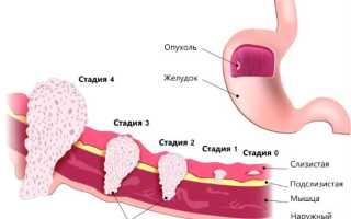 Стадии рака желудка