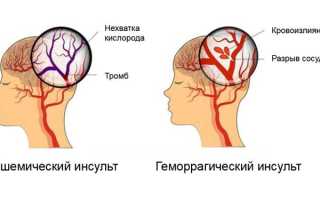 Признаки наступающего инсульта