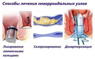 Методы лечения геморроя у женщин, как правильно лечить геморроидальные узлы?