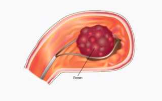 Разница между полипом и папилломой