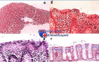 Недифференцированный колит