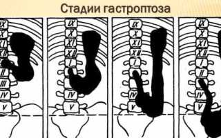 Опущение желудка – гастроптоз