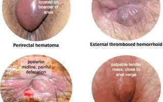 Обостренный (острый) наружный и внутренний геморрой
