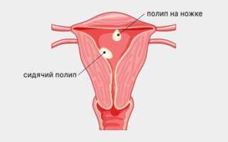 Может ли кровоточить полип?