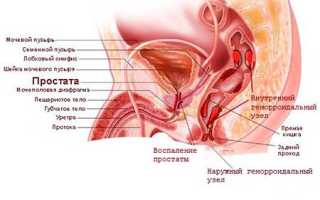 Какая связь между геморроем и простатитом?