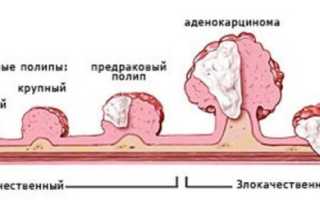 Злокачественный полип