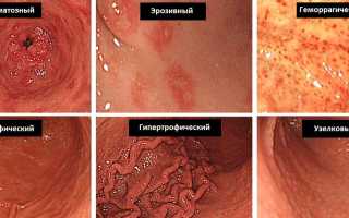 Гипертрофический гастрит: виды