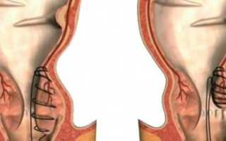 Современная терапия геморроя