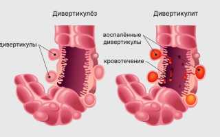 Болезнь дивертикулит кишечника – острое и хроническое воспаление дивертикула