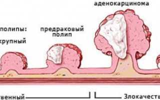 Полип пищевода