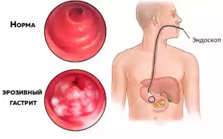 Эрозивный гастрит с поражением (атрофией) антрума
