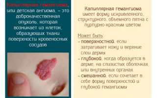 Гемангиома доброкачественная опухоль