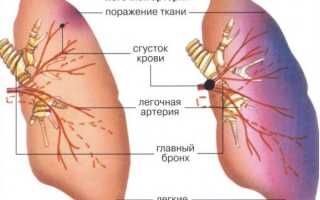 Гипертрофия правого предсердия р острый