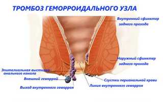 Воспаление геморроидальных узлов (вен)