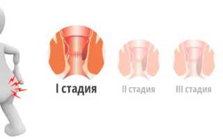 Геморрой на начальной (ранней) стадии легкой 1 (первой) степени