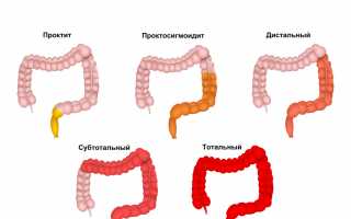 Язвенный колит дистальная форма