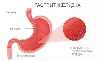 Что такое гастрит желудка, его виды, причины возникновения, признаки, симптомы, диагностика, лечение