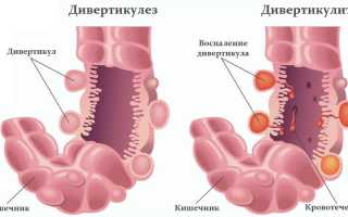 Как лечить дивертикулиа кишечника, сигмовидной кишки, пищевода?