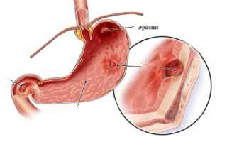 Гастрит эрозивный дуоденит