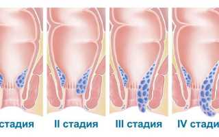 Не проходят геморроидальные шишки, что делать?