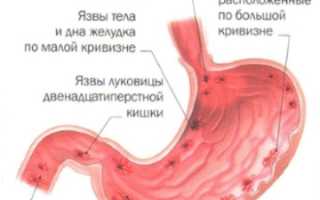 Обострение язвенной болезни желудка: причины и лечение