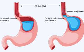 Рефлюкс гастрит: эритематозный, смешанный, умеренный. Причины и диагноз