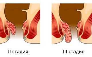 Хронический комбинированный (смешанный) геморрой 1, 2, 3, 4 степени