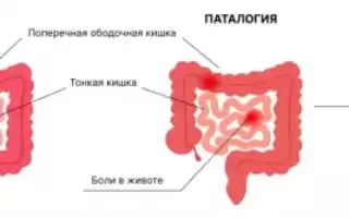 Аллергический спастический энтероколит