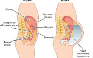 Излечим ли асцит брюшной полости?