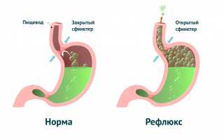 Метеоризм при гастрите