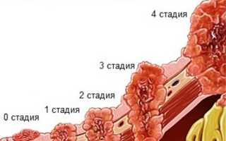 Покажет ли УЗИ рак желудка: виден ли он, можно ли его увидеть?