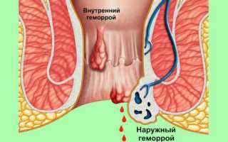 Можно ли проколоть геморрой?