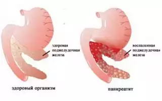 Разложение поджелудочной железы, что делать, если  разложилась?