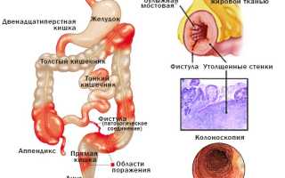 Болезнь Крона толстой кишки, симптомы и лечение