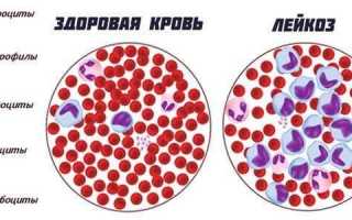 Лейкемия симптомы у взрослых причины возникновения