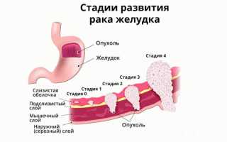 Недифференцированный рак желудка и его прогноз