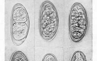 Острицы (энтеробиоза) в печени