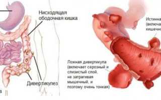 Дивертикулез ободочной кишки