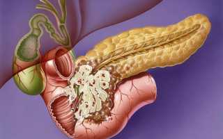 Сколько живут с раком поджелудочной железы, продолжительность жизни, возраст