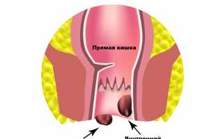 После запора боль в заднем проходе (анальном отверстии, анусе)