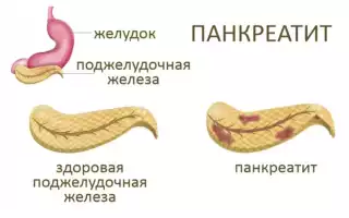 Лечение панкреатита в домашних условиях, как лечить поджелудочную железу дома?