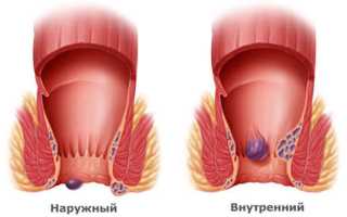 Что делать, если лопнул геморрой?