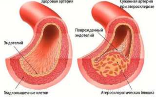 Чем чистить сосуды организма и укреплять стенки
