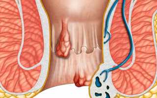 Запор и зуд в заднем проходе